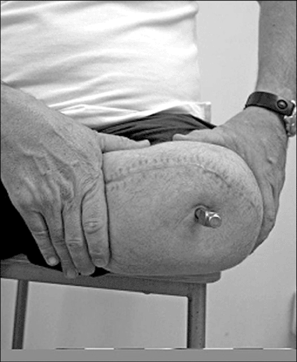 Image: An example of skin penetration area and the abutment protruding from the residual limb (photo courtesy Sahlgrenska University Hospital).